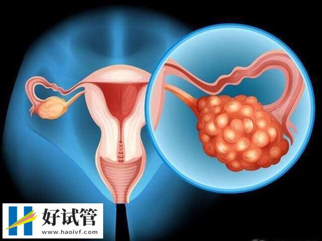 多囊促排后怀孕的几率有多大(图1)